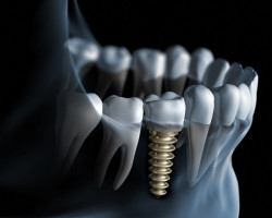 Implanty 3 implant stomatologiczny