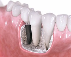 Implanty 4 implant dentystyczny