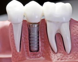 Implanty 5 implant stomatologiczny